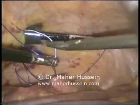 Jejunostomy tube insertion - Laparoscopy