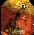 Gastric Band Erosion - Endoscopic View