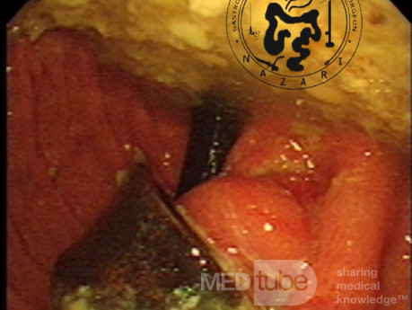 Gastric Band Erosion - Endoscopic View