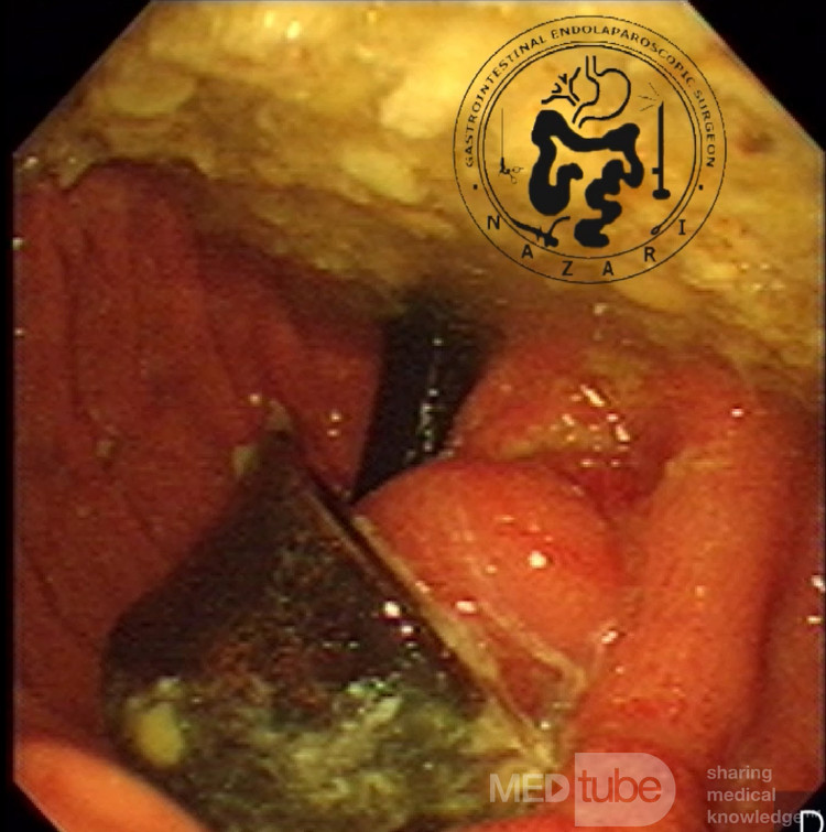 Gastric Band Erosion - Endoscopic View