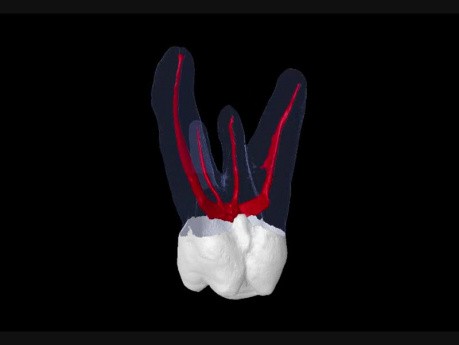Maxillary Second Molar - 3