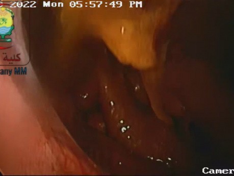 Extensive Intraperitoneal Adhesions