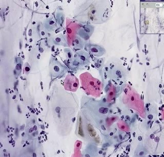 Low grade squamous intraepithelial l - Histopathology - Cervix
