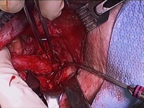 Posterior Urethroplasty With Gracilis Muscle Flap