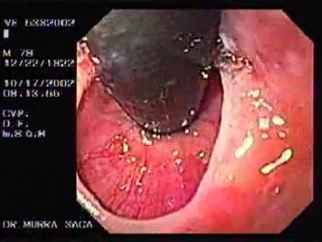 Esophagus Schatzki Ring (2 of 3)