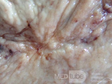 Small Gastric Adenocarcinoma of the Diffuse Ring Cell (12 of 19)