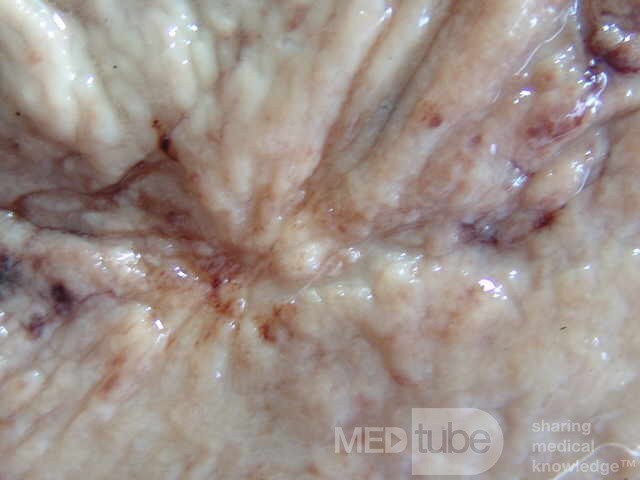 Small Gastric Adenocarcinoma of the Diffuse Ring Cell (12 of 19)