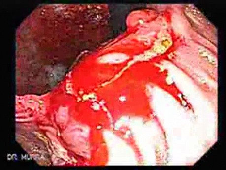 Recurrent Gastric Cancer after Gastrectomy Billroth II (1 of 6)