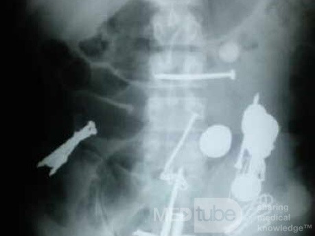 Multiple Foreign bodies in the GI tract (1 of 12)