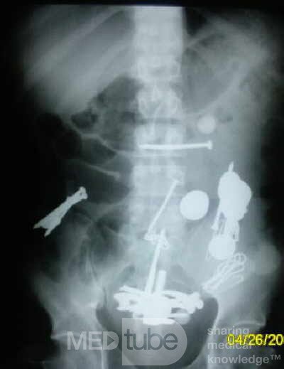 Multiple Foreign bodies in the GI tract (1 of 12)