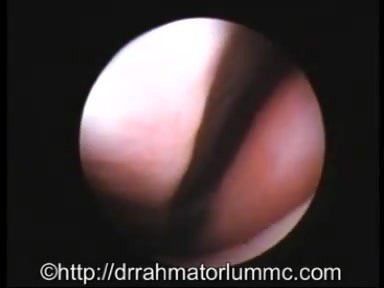 Tonsils: Tubal and Peri-Tubal 