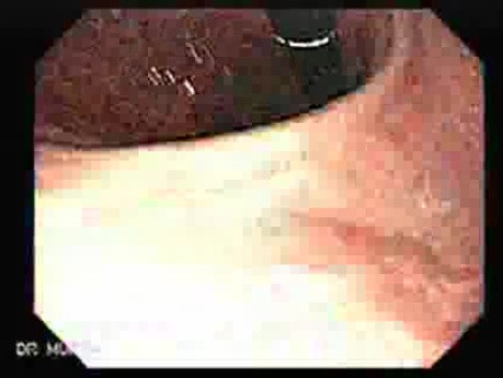 Hourglass Stomach - Follow Up After Two Months, Retroflexed View, Part 4