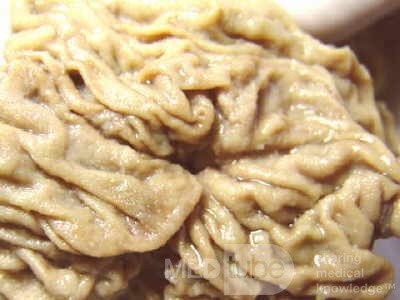 Cholangiocarcinoma that infiltrated a Periampullary Duodenal Diverticula and the head of the pancreas (5 of 20)