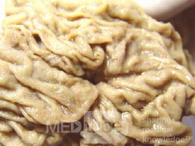 Cholangiocarcinoma that infiltrated a Periampullary Duodenal Diverticula and the head of the pancreas (5 of 20)