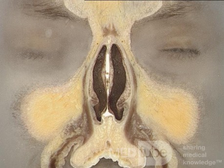 Coronal Anatomy of the Nose and Paranasal Sinuses: Slice 1