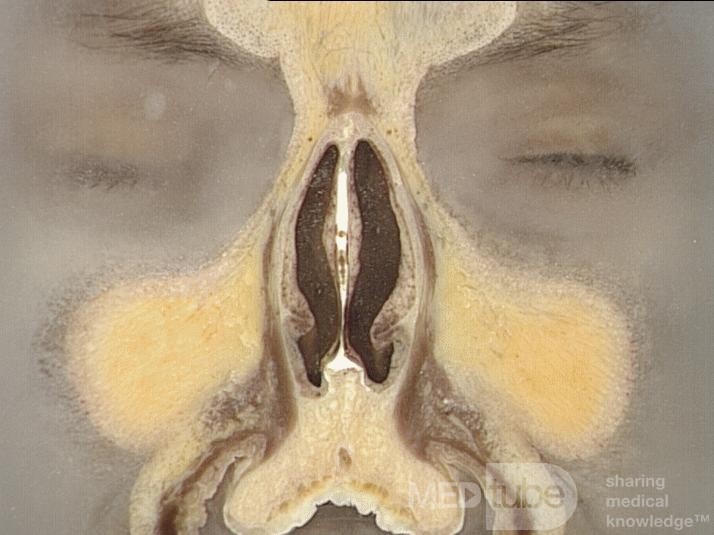 Coronal Anatomy of the Nose and Paranasal Sinuses: Slice 1