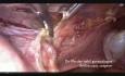 Step by Step Laparoscopic Subtotal Hysterectomy (Fully Narrated Technique)
