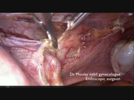 Step by Step Laparoscopic Subtotal Hysterectomy (Fully Narrated Technique)