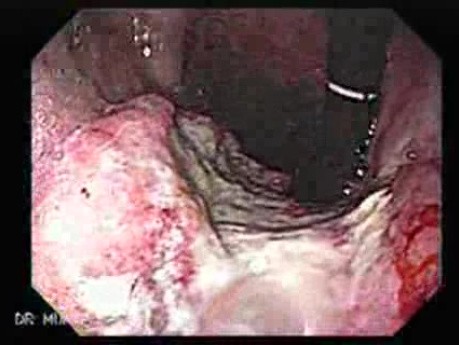 Gastric Adenocarcinoma With Varices - Endoscopy (3 of 8)