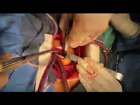 Massive Marantic Pulmonary Embolism 