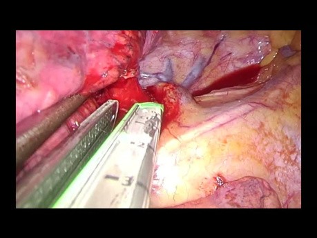 Uniportal VATS right upper lobectomy NON EDITED SURGERY
