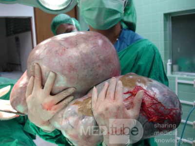 Giant Ovarian Serous Cystadenoma