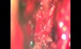 Lumbar Microdiscectomy