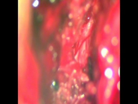 Lumbar Microdiscectomy