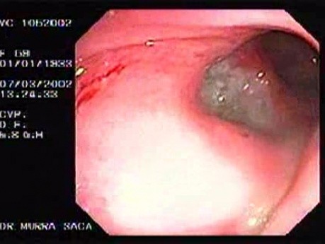 Recto-vaginal Fistula (1 of 3)