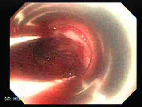 Ligation of Esophageal Varices -  Attempt of Banding