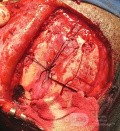 Surgical Planning with Neuronavigator in Patient with Intracranial Mass Lesion. High Grade Glioma.