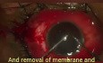 Management of Cattlehorn Ocular Injury