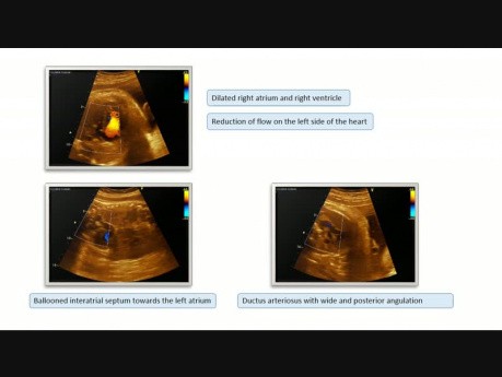 Restrictive Foramen Ovale in Fetal Period and Post Natal Process