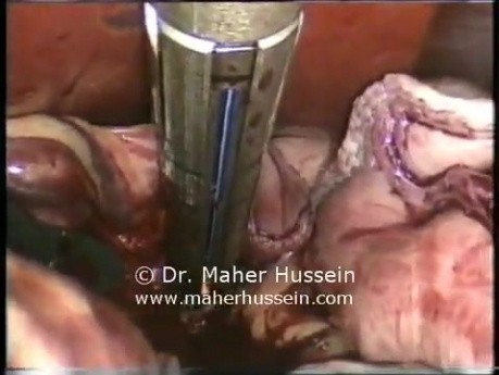 Laparoscopic Sleeve Gastrectomy