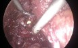 Retizus Sparing Laparoscopic Radical Prostatectomy