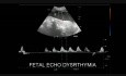 Fetal Echo Dystrthymia