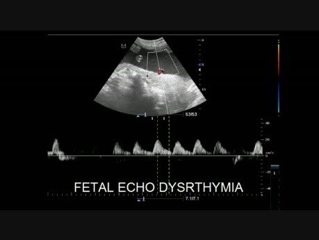 Fetal Echo Dystrthymia