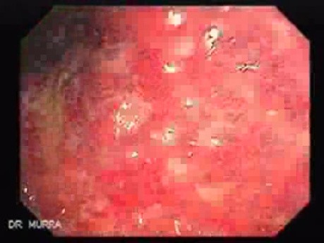 Multiple Rectal Ulcers (9 of 110)