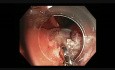 Colonoscopy - IC Valve EMR - Hot Biopsy Avulsion - APC - Clip Closure