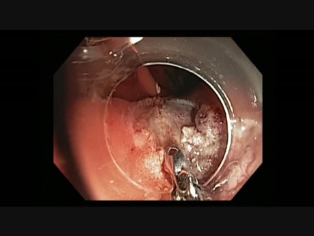Colonoscopy - IC Valve EMR - Hot Biopsy Avulsion - APC - Clip Closure