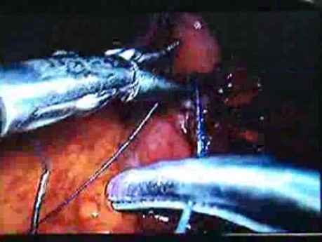 Jejunal Gastrointestinal Stromal tumor (GIST) (50 of 86)