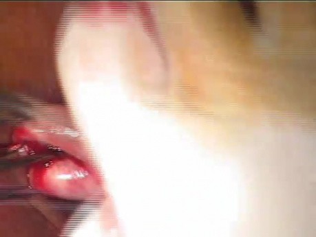 Removal of the Uterus Through the Vagina, Part 1