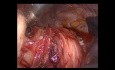 Thoracoscopic Esophageal Leiomyoma Surgery