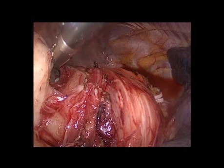 Thoracoscopic Esophageal Leiomyoma Surgery