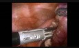 Salpingectomy Fallopian Tube Torsion