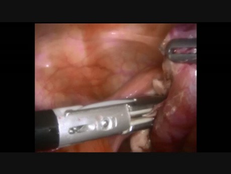 Salpingectomy Fallopian Tube Torsion