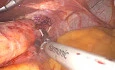 Nissen Laparoscopic Surgery Case