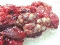 Metastasis of Renal Carcinoma to the ascending colon (10 of 11)