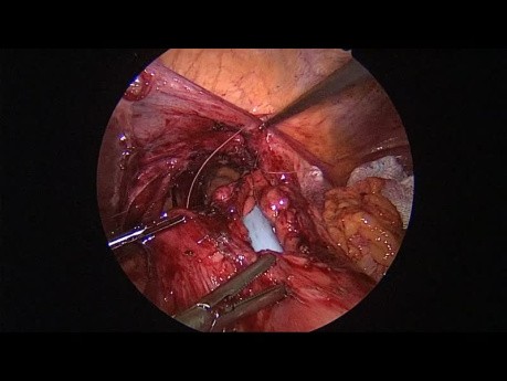 Laparoscopic Treatment of a Penetrating Ulcer to the Pericardium in a Hiatal Hernia