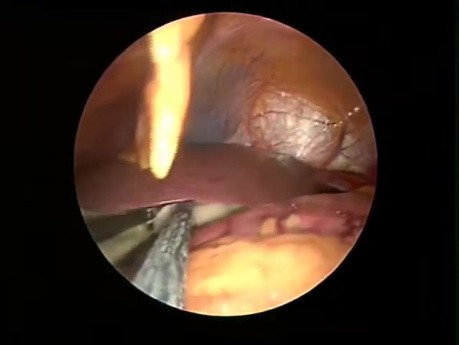 Single Skin Incision (SPA) Hepatic Sling Insertion